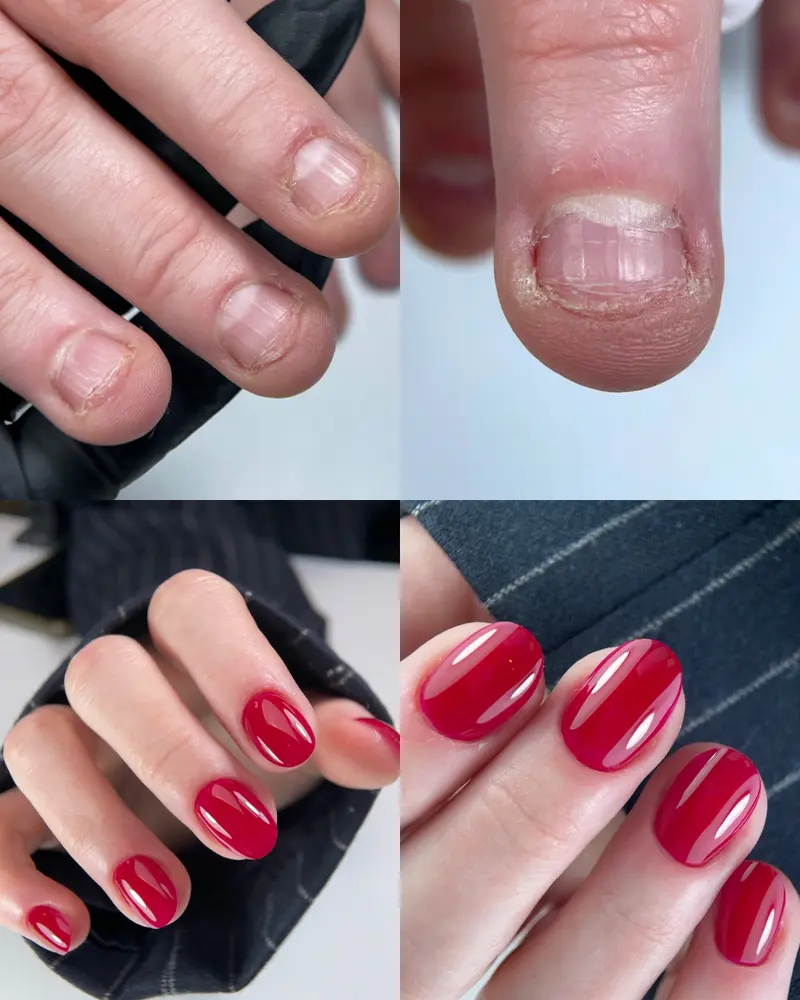 [AA30] NAGELBIJTER + NAGELBIJTER NABEHANDELING